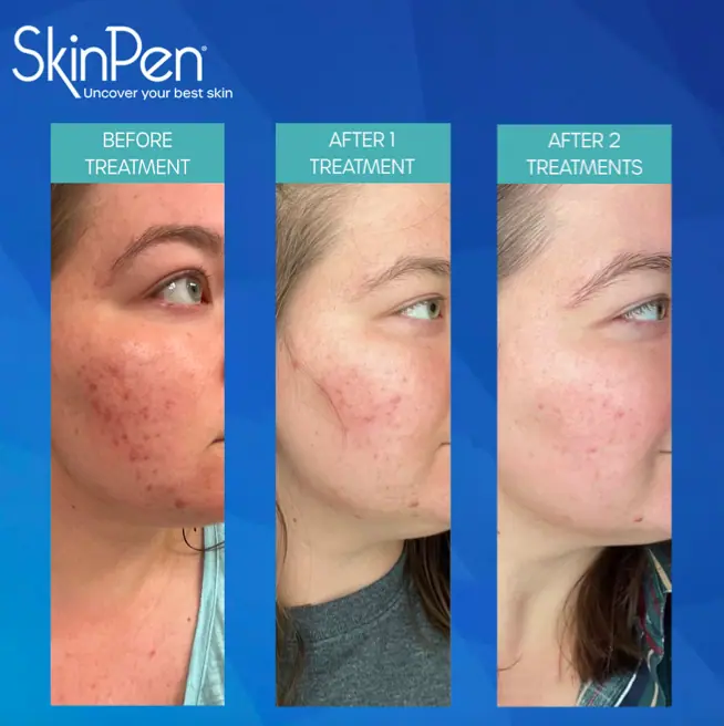 Skinpen before and after2