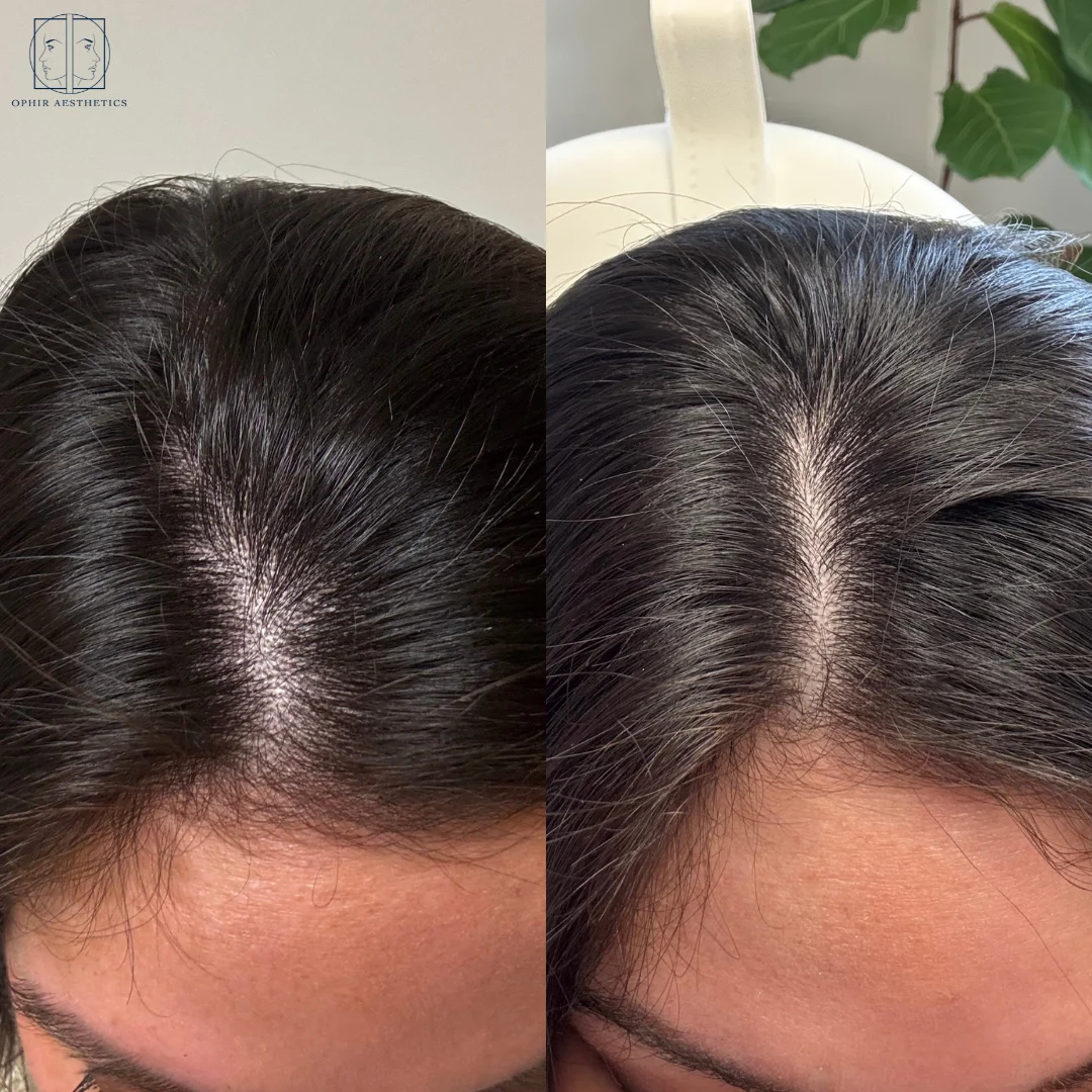 hair-restoration-before-after-one