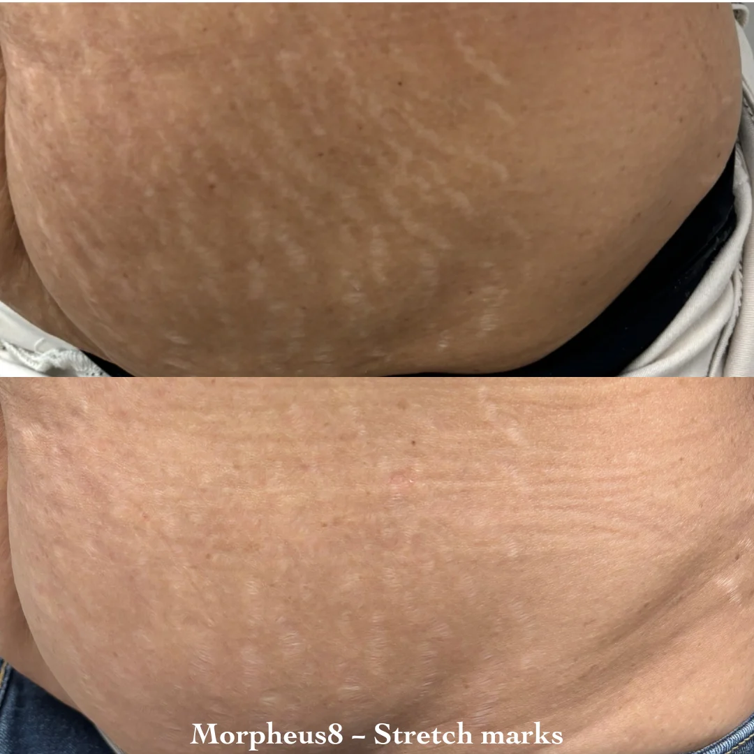 morpheus-before-after