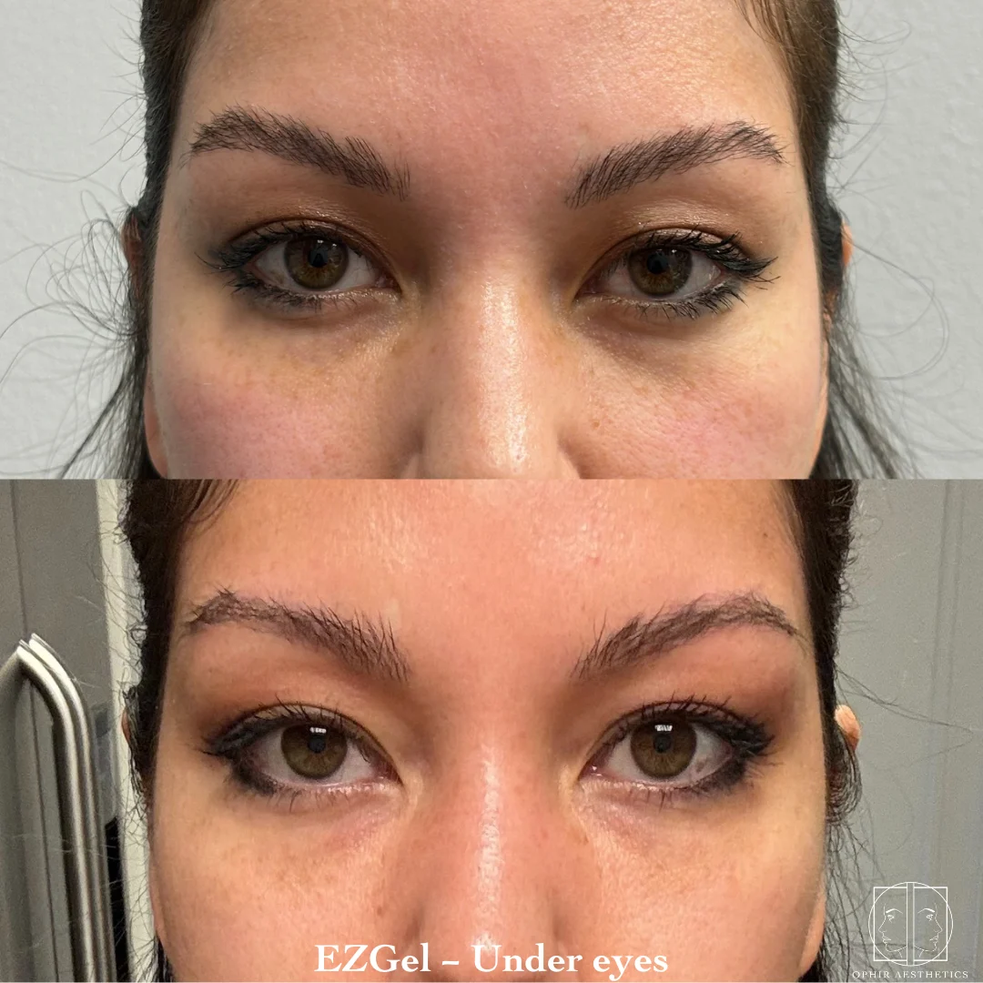 prf-before-after