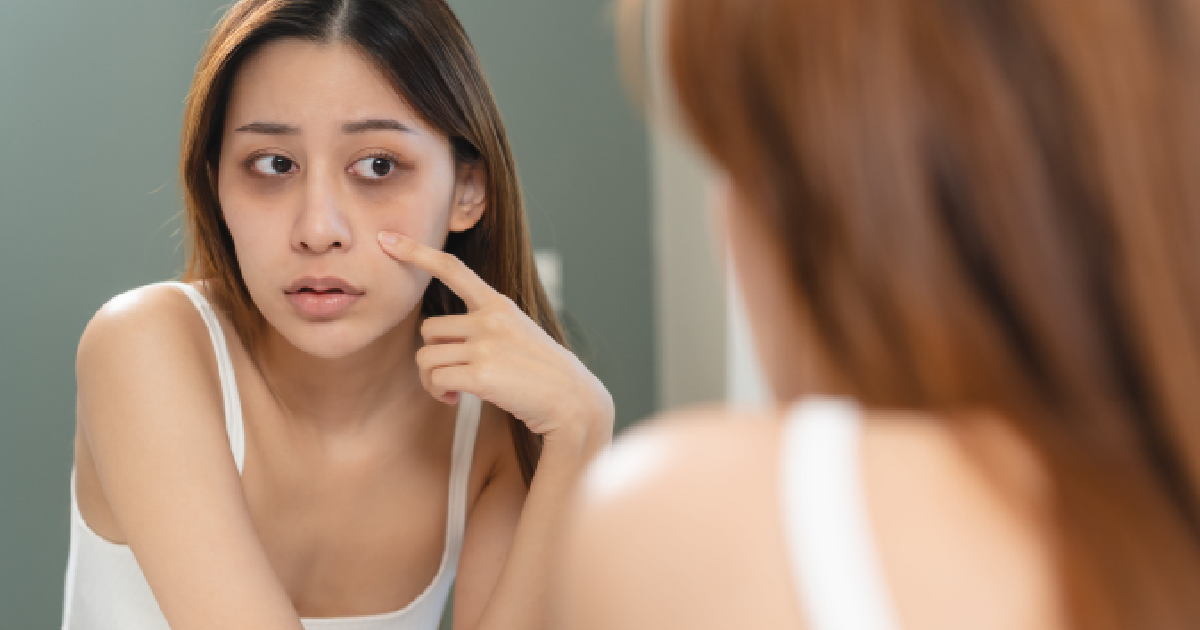 Exosomes in Lake Stevens, WA: Exosome Therapy for Dark Circles and Under-Eye Bags